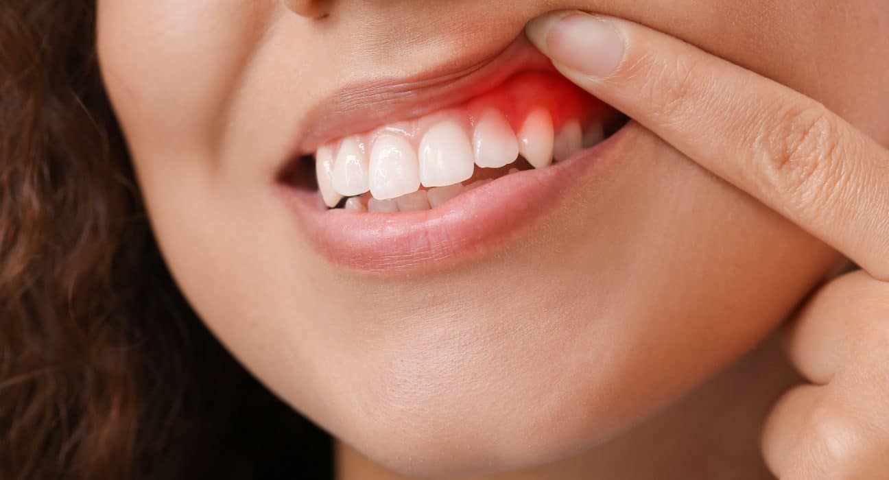 Comment percer un abcès dentaire naturellement ?