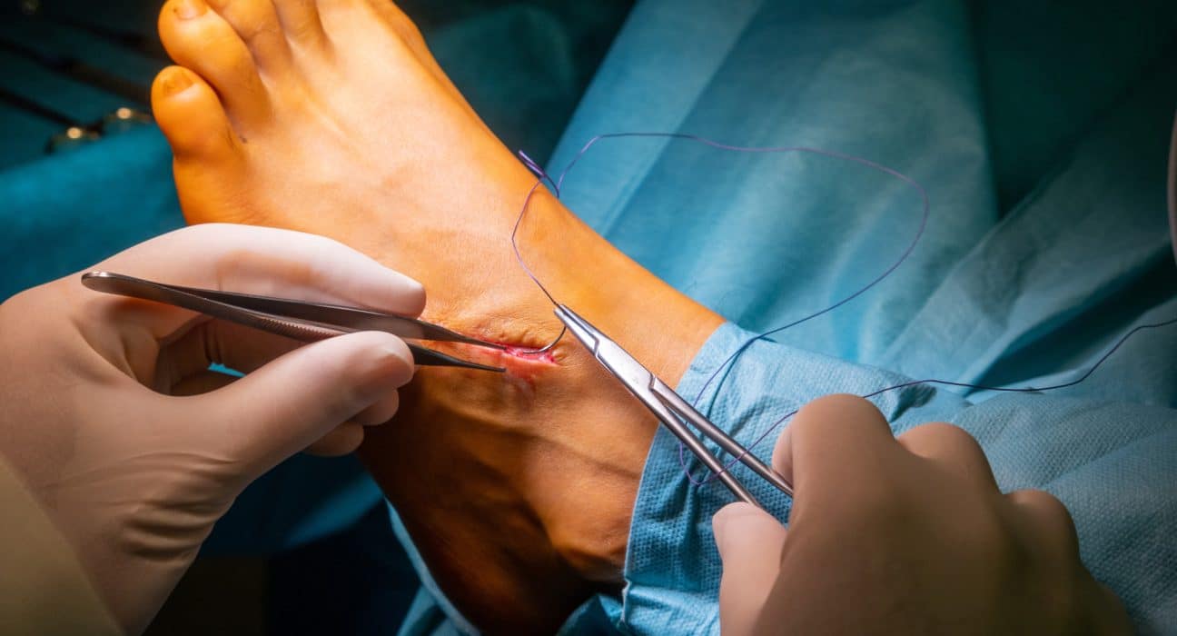 fil résorbable douleur